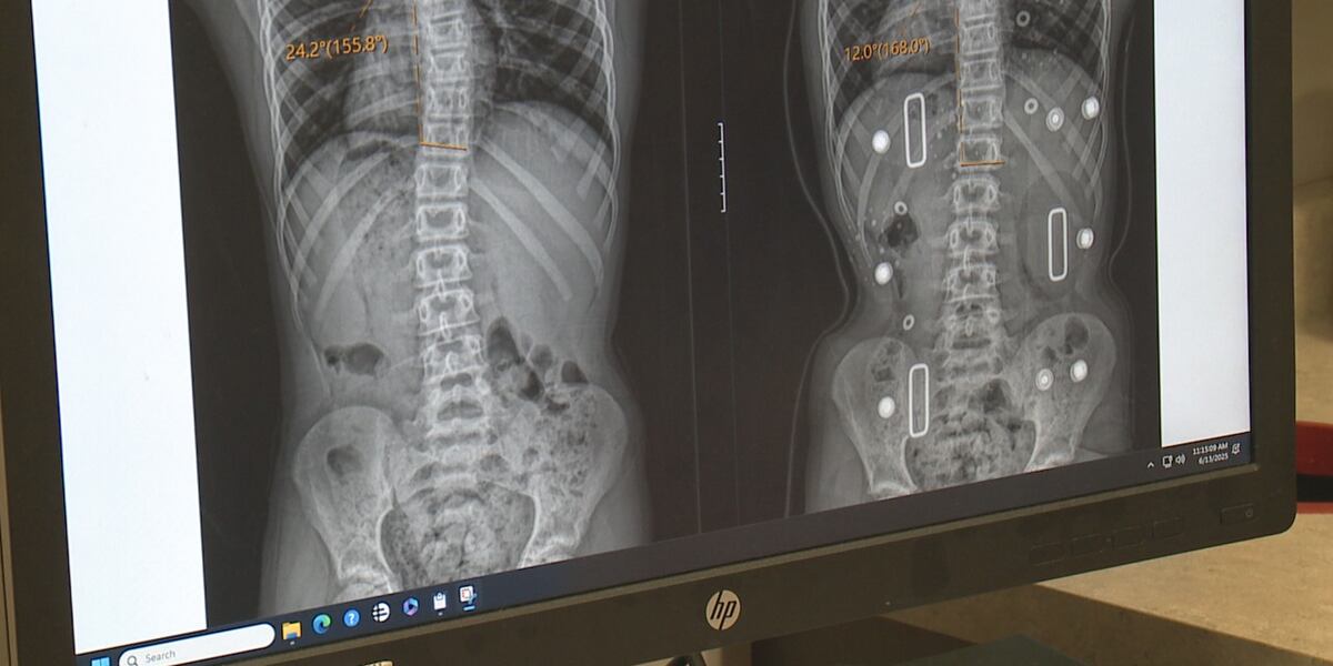 Magik Rods “Magic Rods” helping treat scoliosis